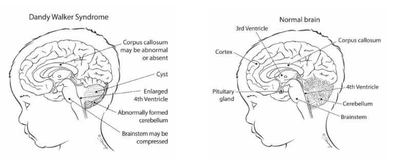 Dandy Walker Syndrome - South West Fetal Network